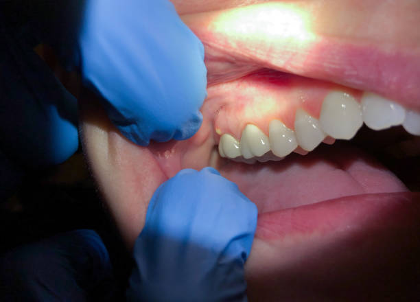 Best Emergency Dental Filling Replacement  in Santa Rosa Valley, CA